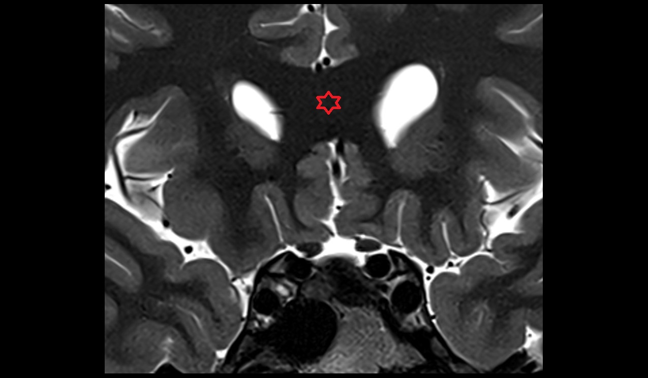 Genu of corpus callosum mri 3t coronal image