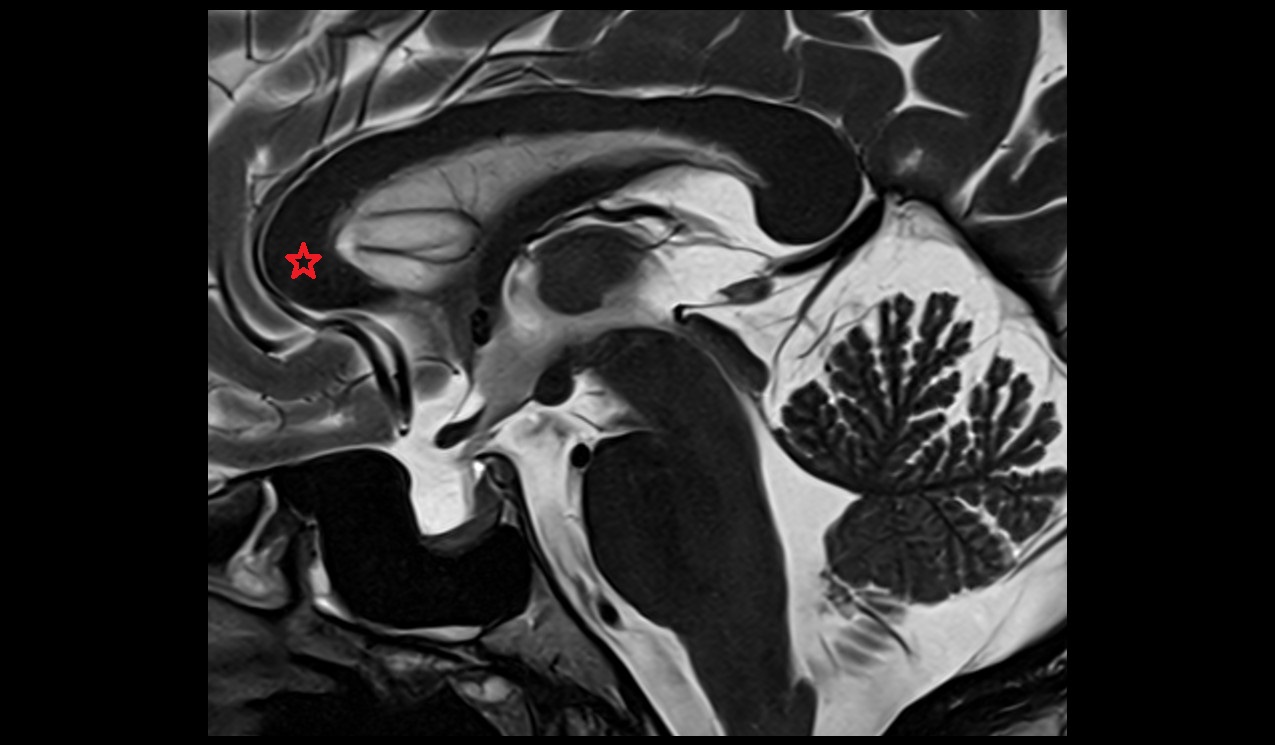 Genu of corpus callosum mri 3t sagittal image