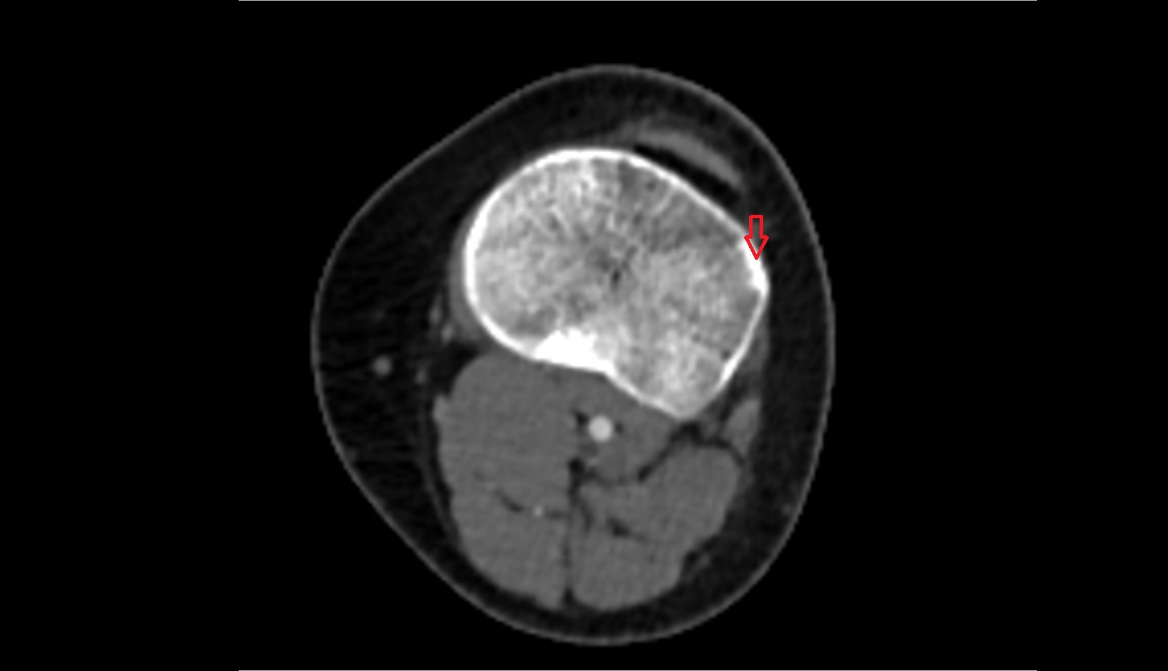 Gerdy’s tubercle axial ct image