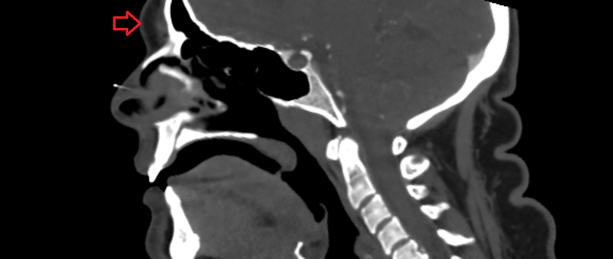 Glabella CT  anatomy labelled image-img-00000-00000