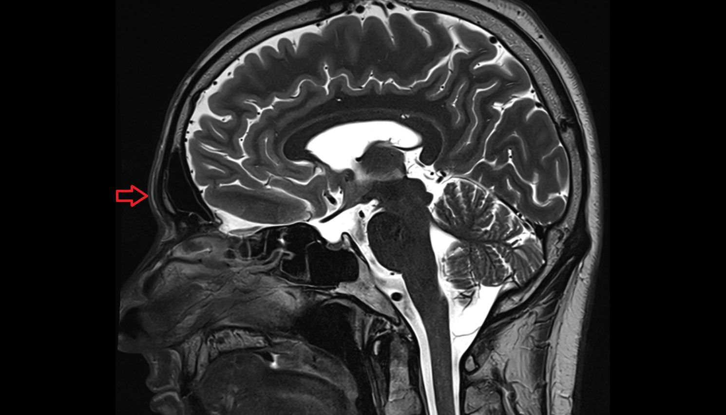Glabella MRI  anatomy labelled image-img-00000-00000