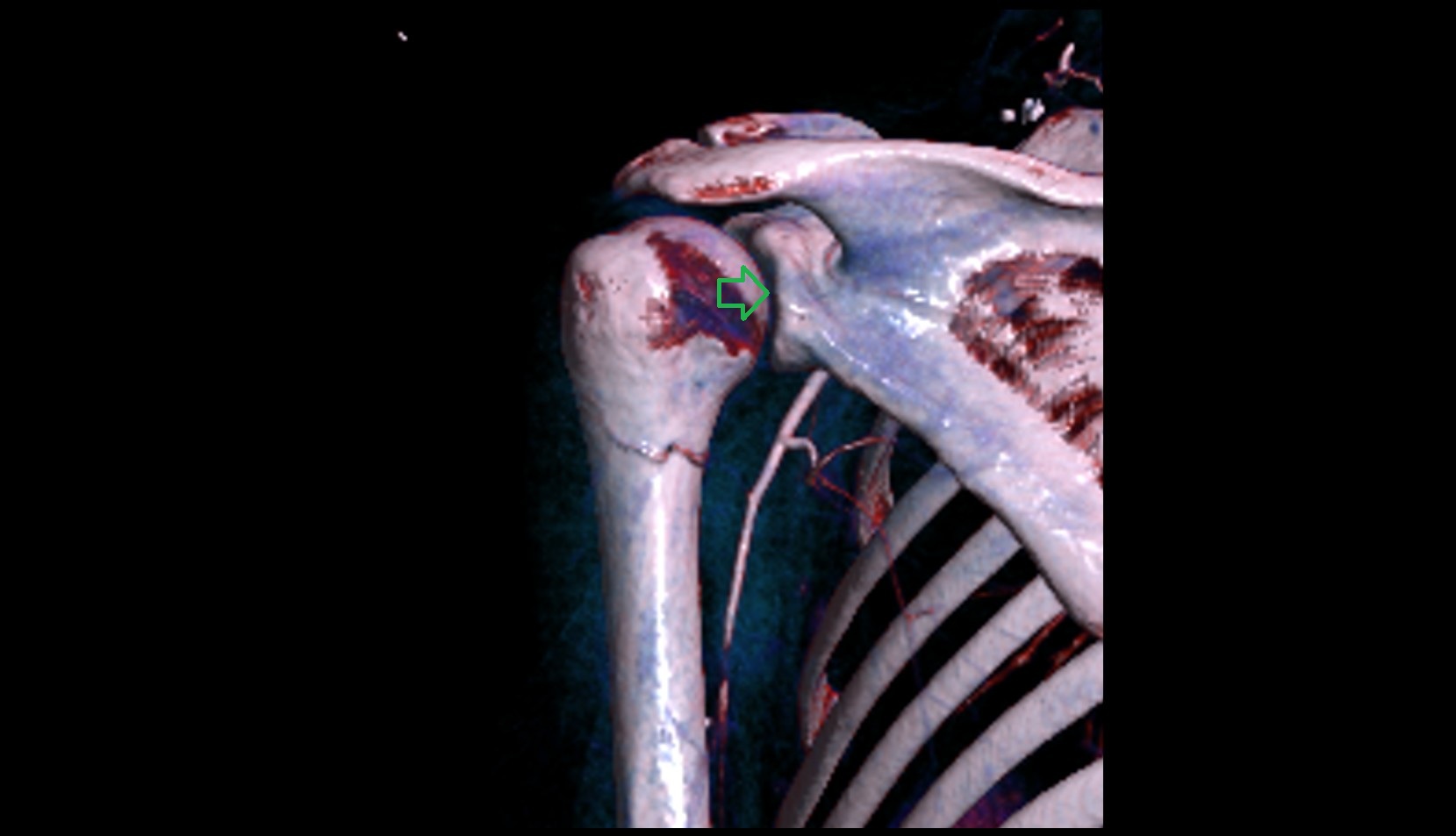 Glenohumeral joint 3D