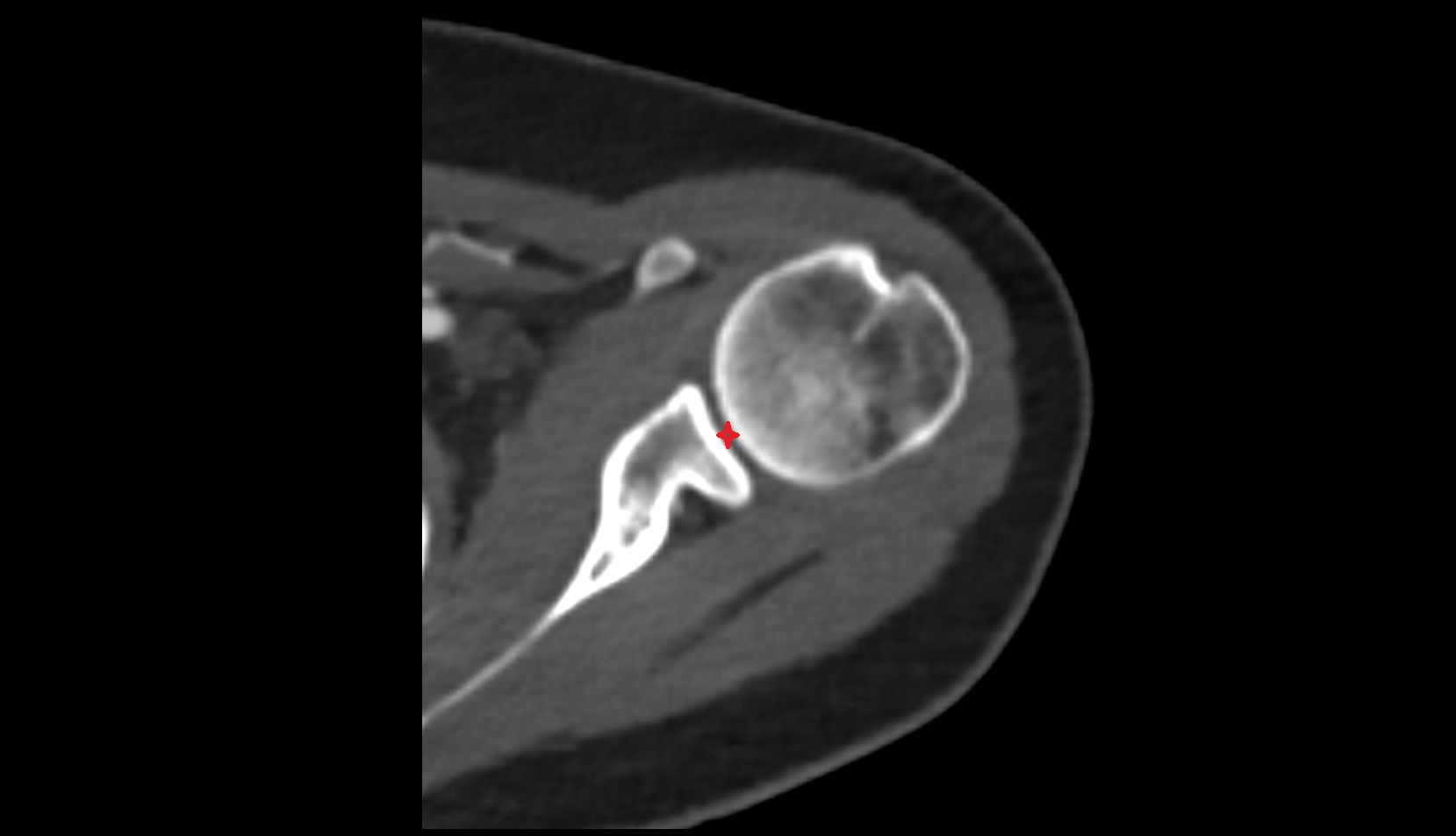 Glenohumeral joint CT IMAGE