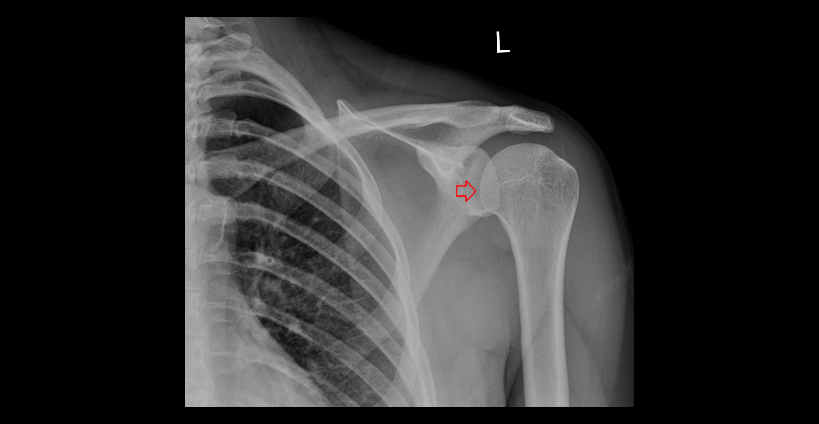 Glenohumeral joint ap