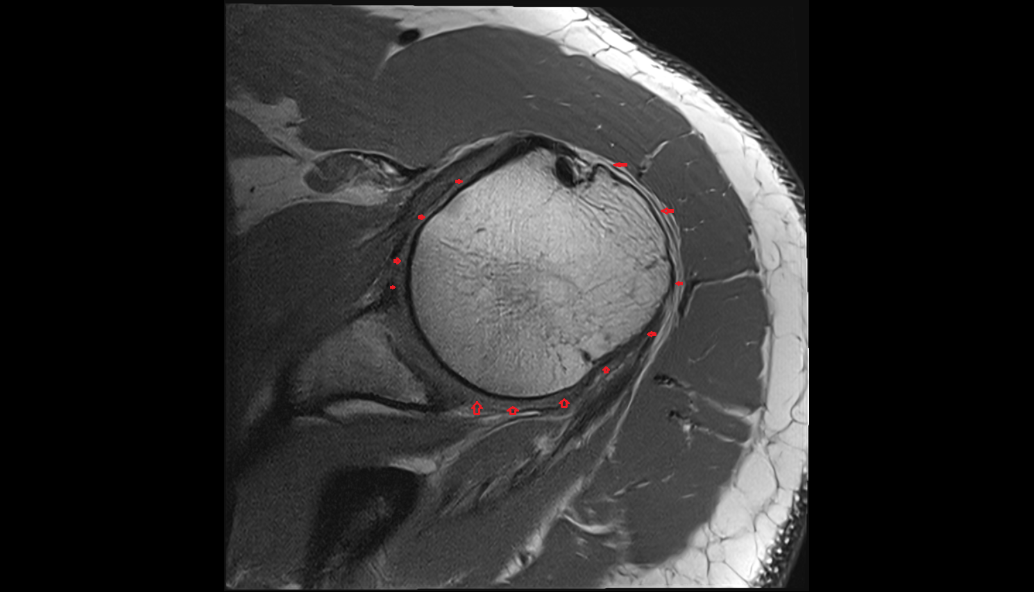 Glenohumeral joint capsule axial cross sectional anatomy 3T MRI AI enhanced radiology image-img-00000-00000