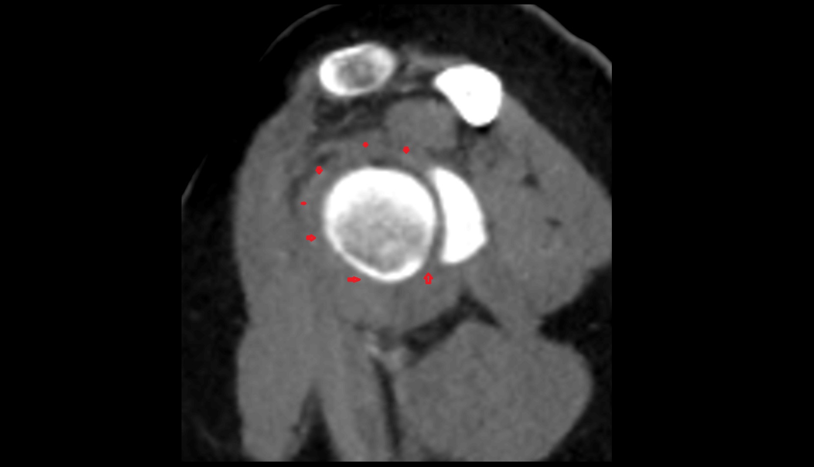 Glenohumeral joint capsule ct sag image