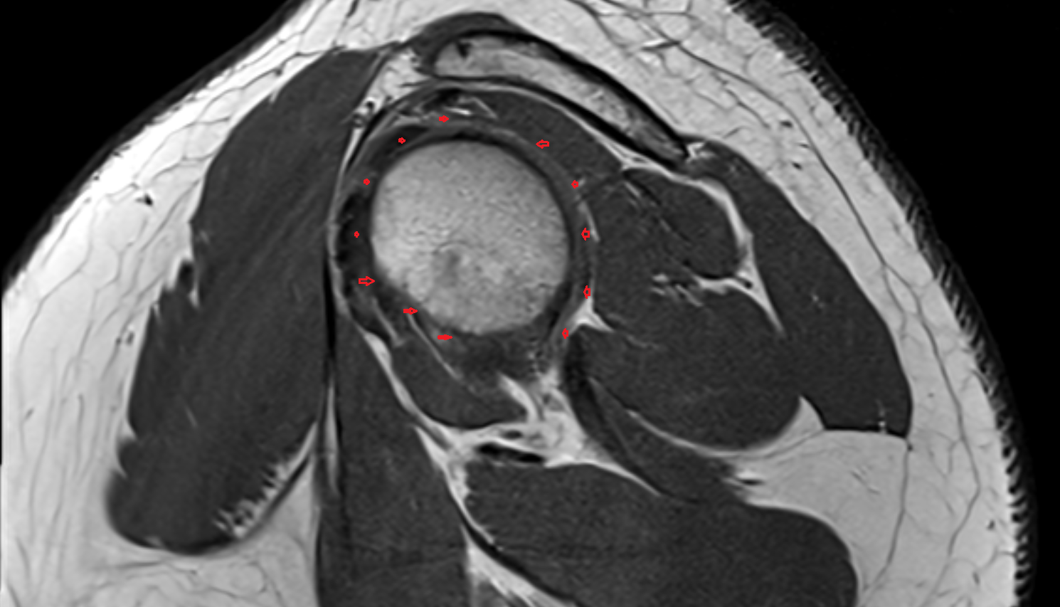 Glenohumeral joint capsule sag cross sectional anatomy 3T MRI AI enhanced radiology image-img-00000-00000