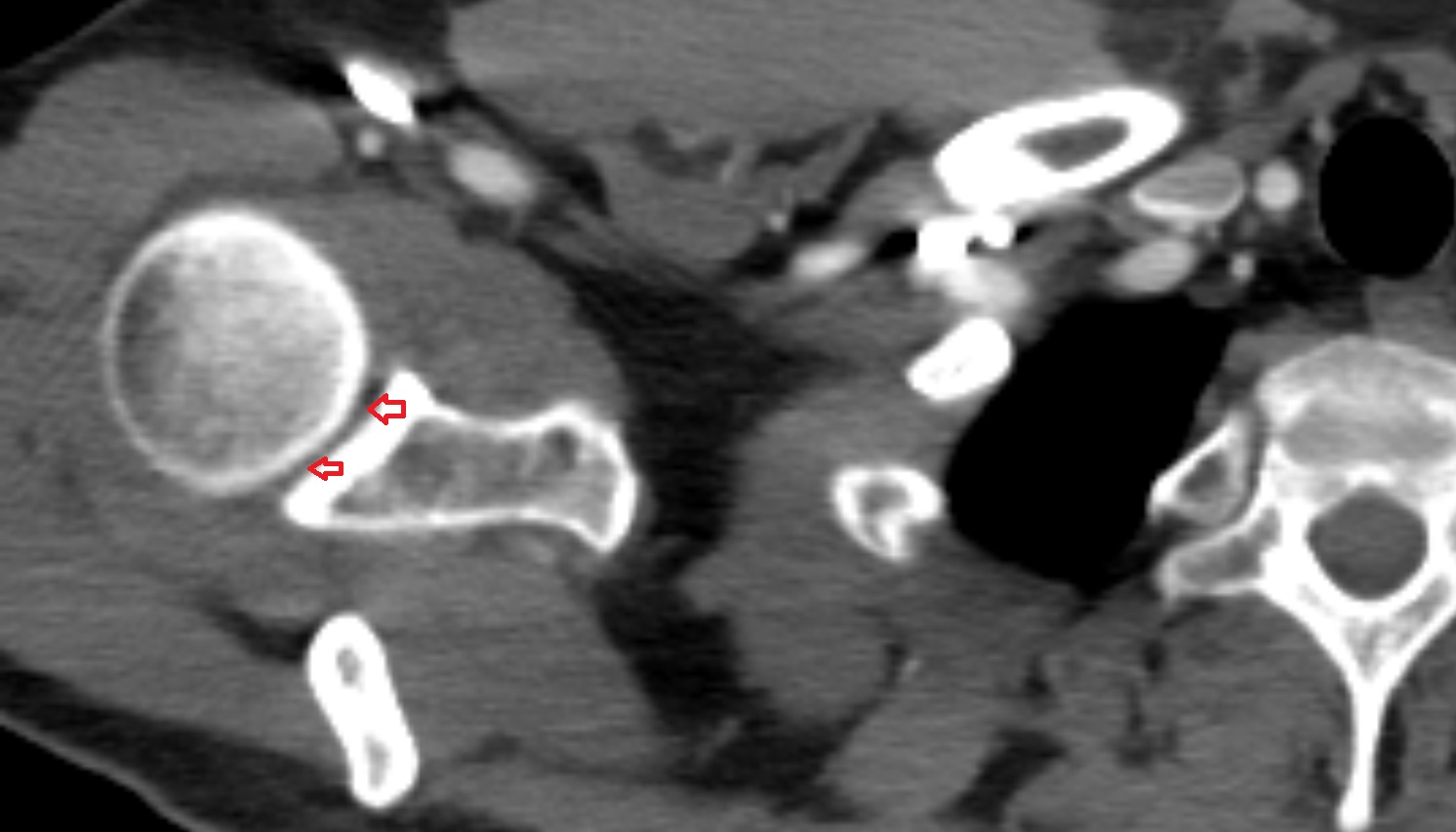Glenoid fossa  CT axial image -img-00000-00000