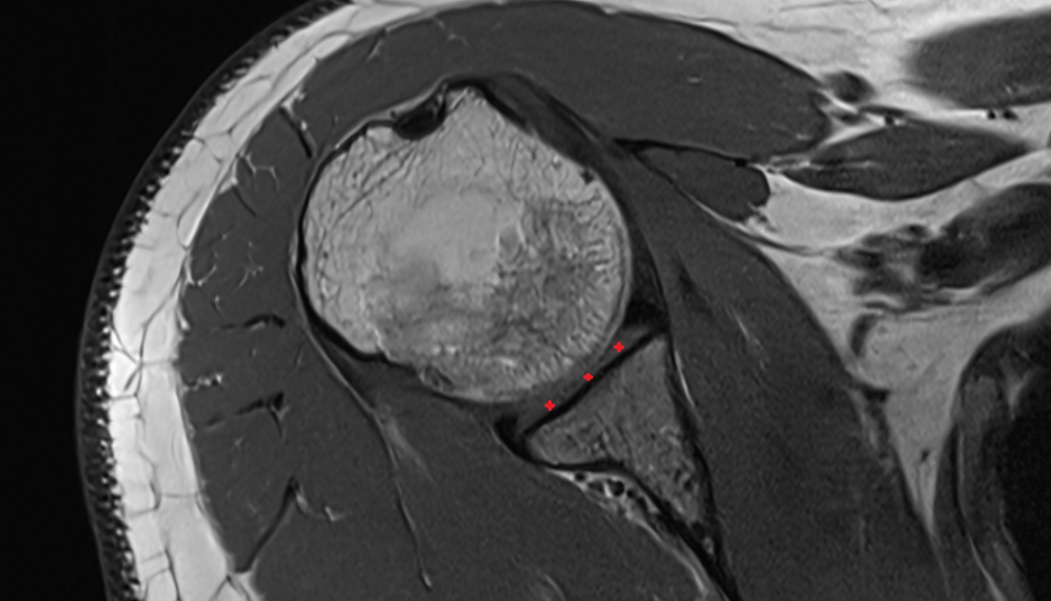 Glenoid fossa  MRI axial image -img-00000-00000