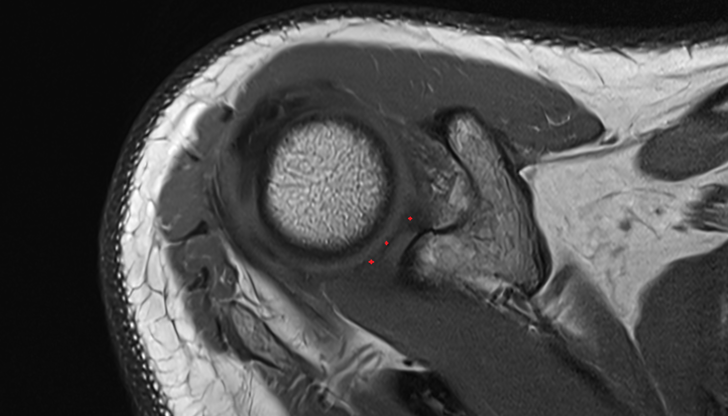 Glenoid labrum axial cross sectional anatomy 3T MRI AI enhanced radiology image-img-00000-00000