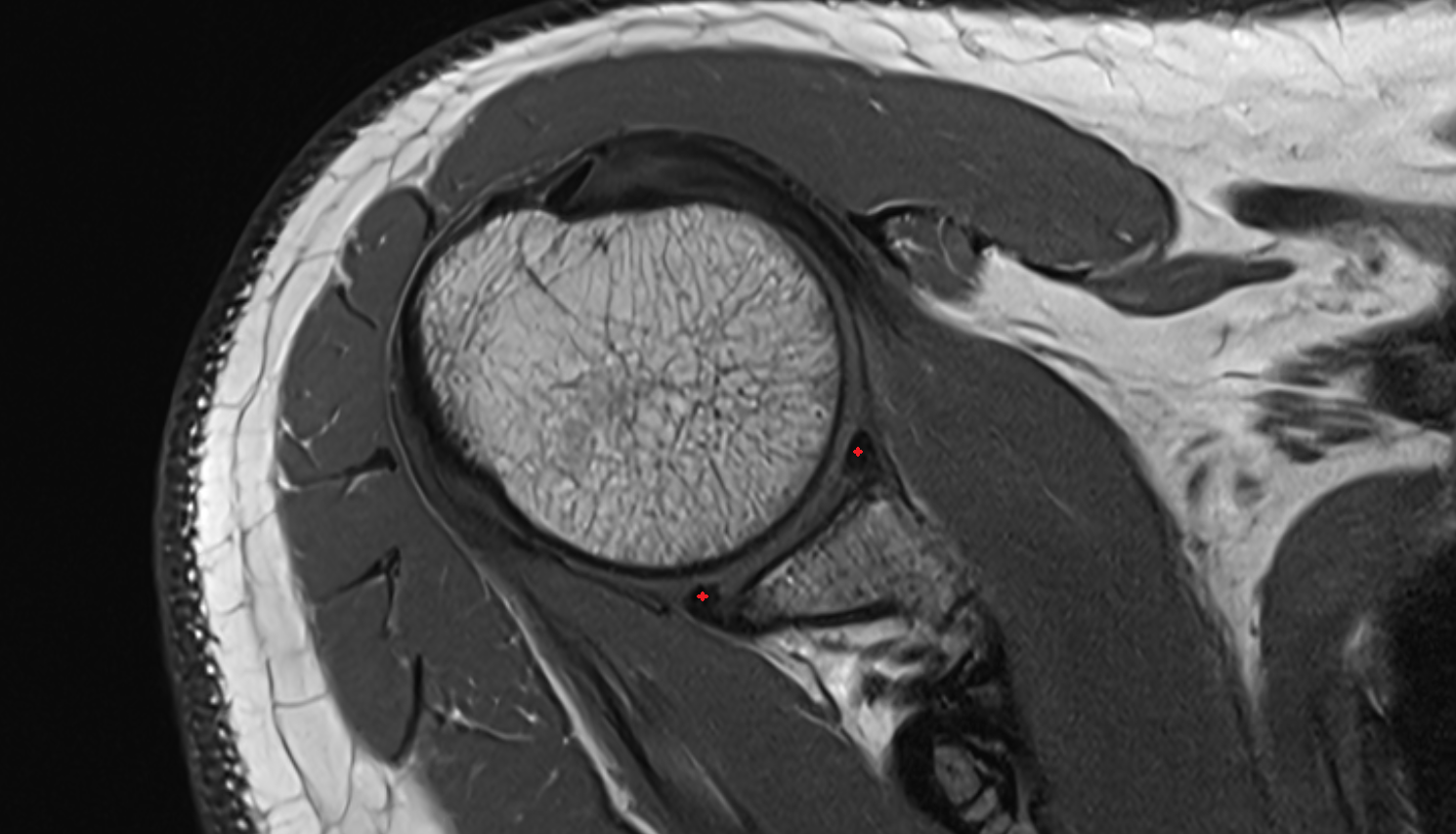 Glenoid labrum axial cross sectional anatomy 3T MRI AI enhanced radiology image-img-00000-00000_00001