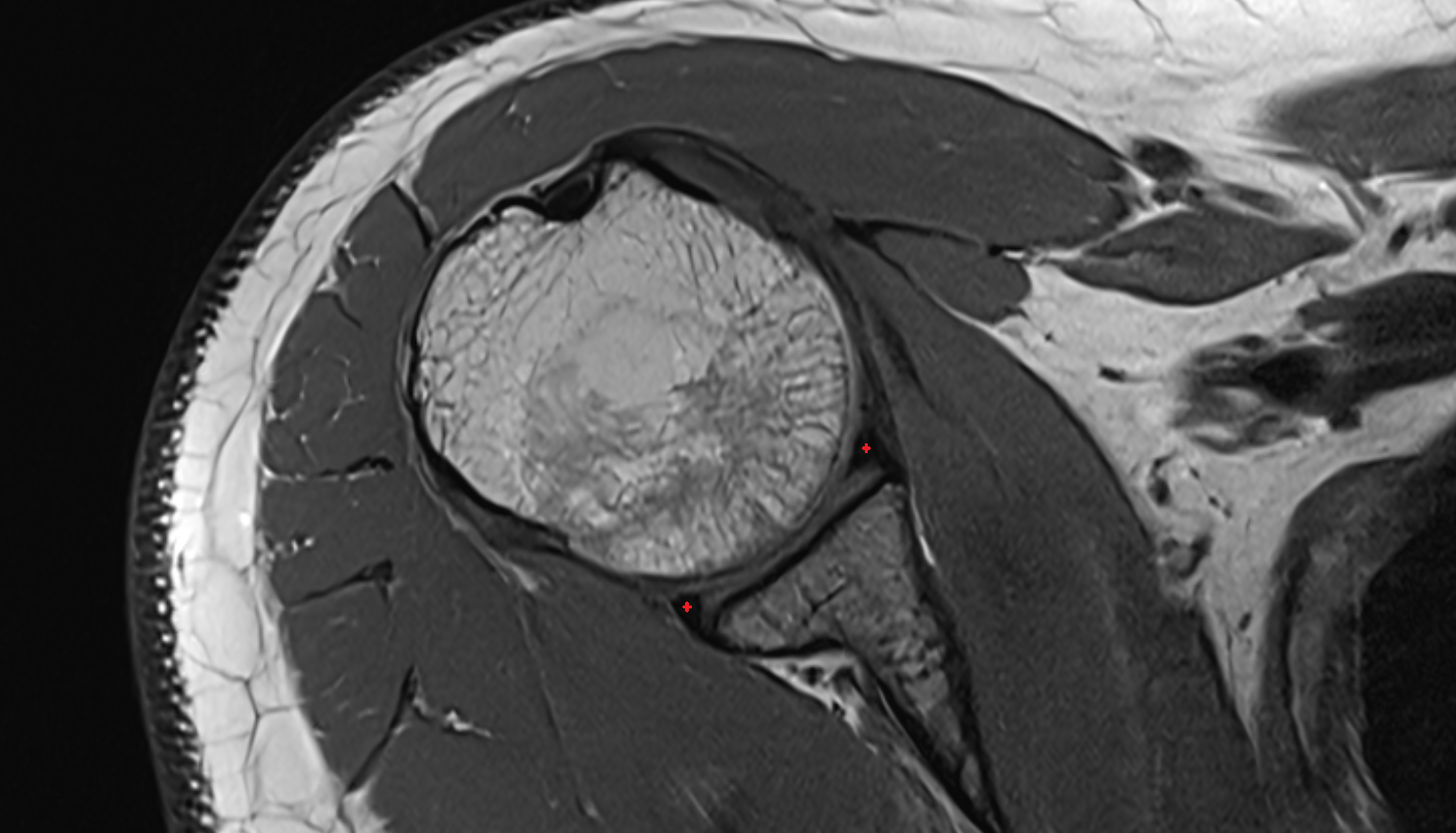 Glenoid labrum axial cross sectional anatomy 3T MRI AI enhanced radiology image-img-00000-00000_00002