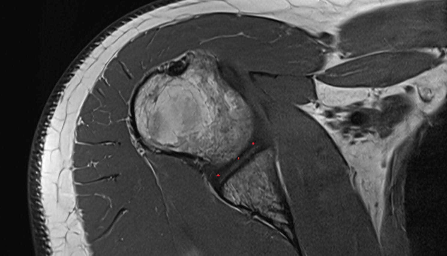 Glenoid labrum axial cross sectional anatomy 3T MRI AI enhanced radiology image-img-00000-00000_00003