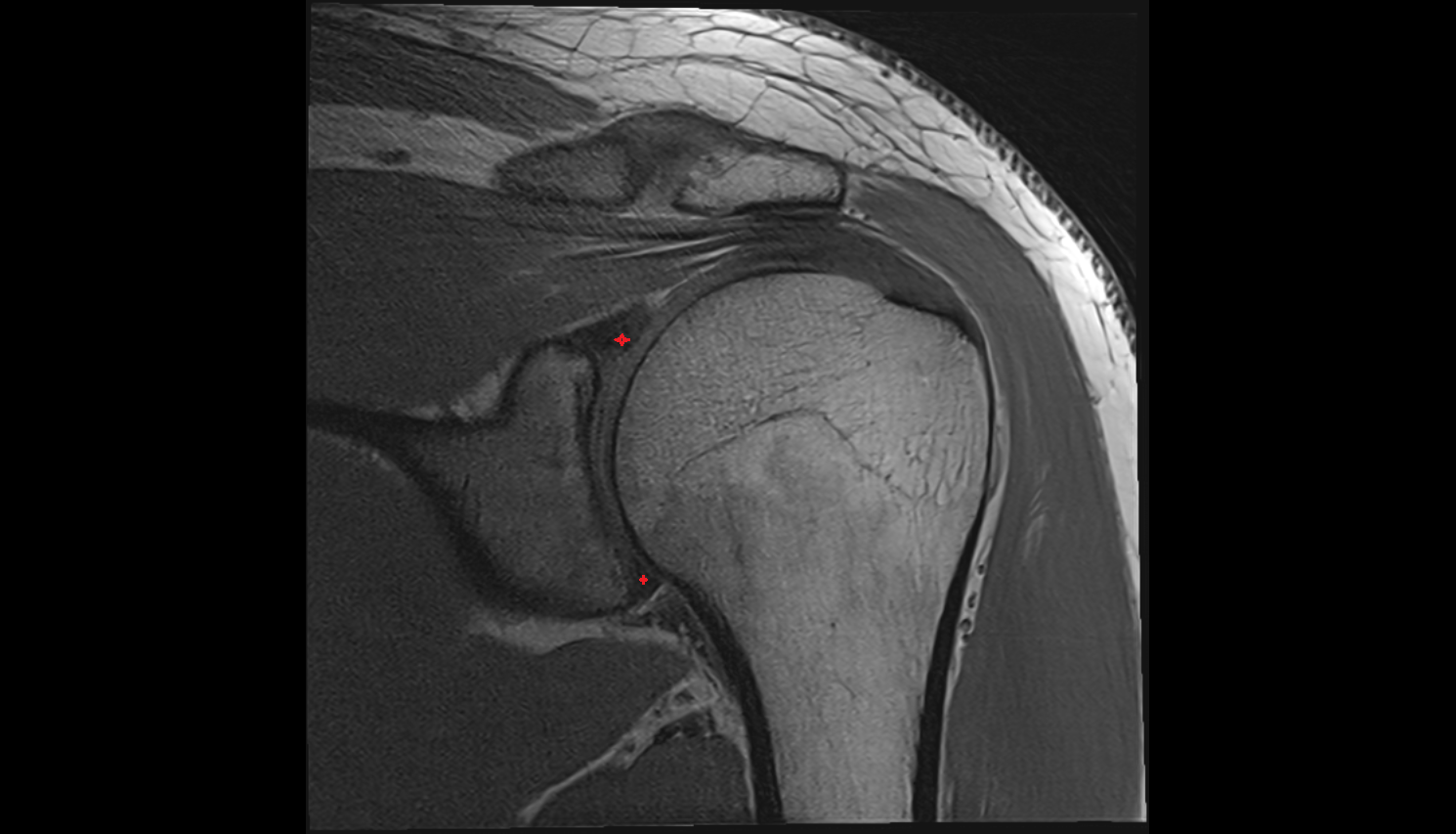 Glenoid labrum coronal cross sectional anatomy 3T MRI AI enhanced radiology image-img-00000-00000