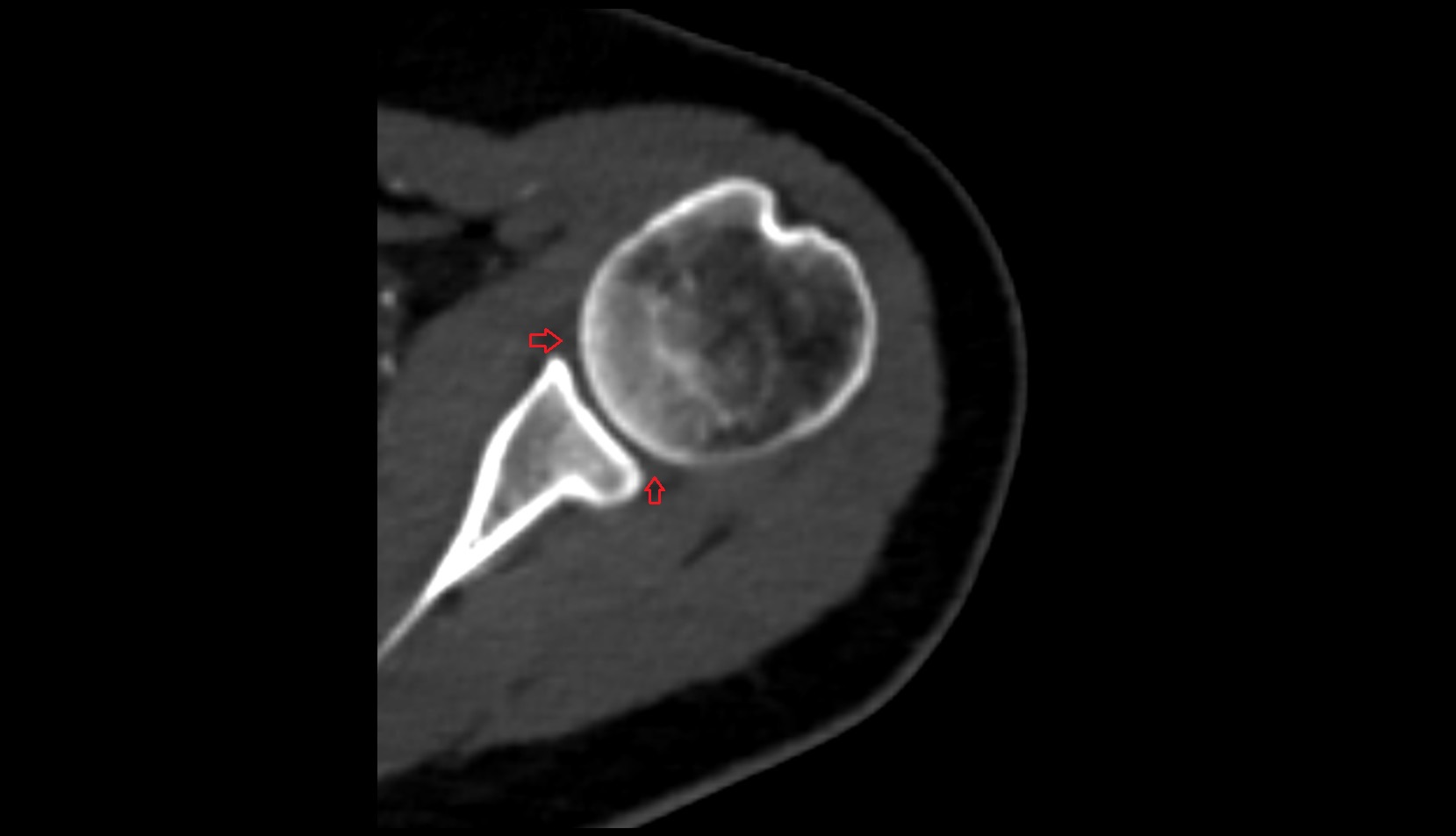 Glenoid labrum ct axial image