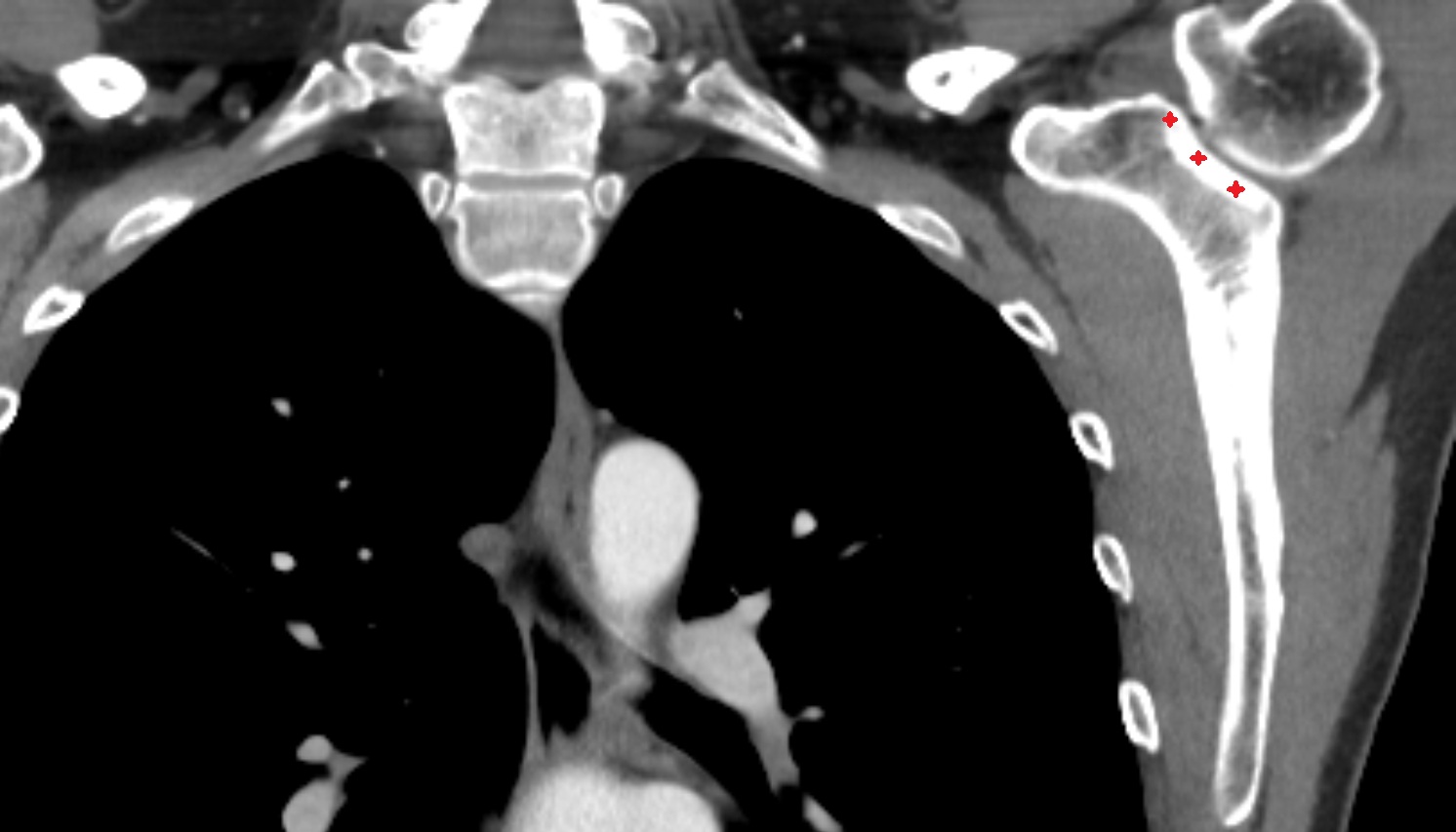 Glenoid process of scapula CT coronal image -img-00000-00000