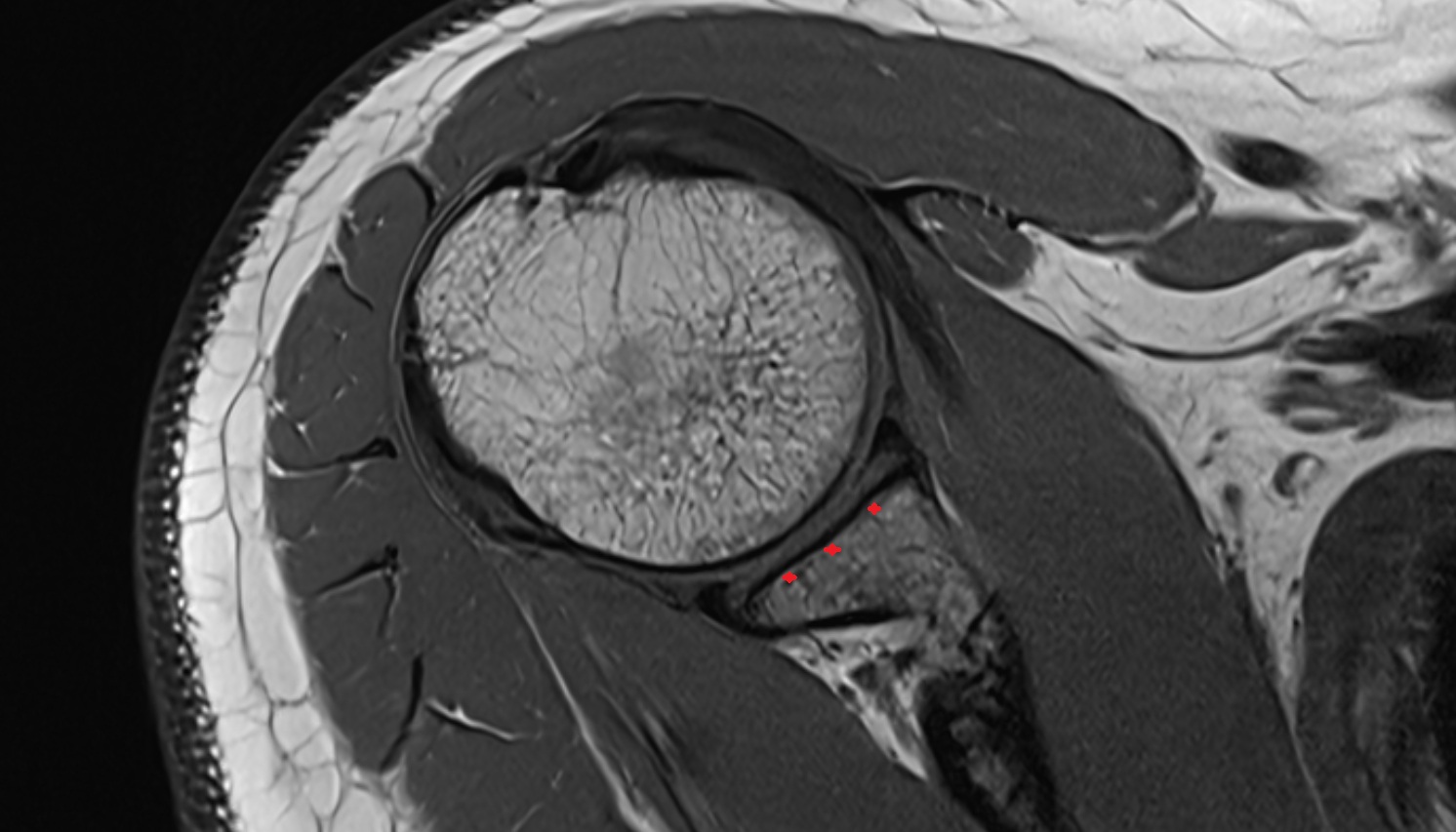 Glenoid process of scapula  MRI axial image -img-00000-00000