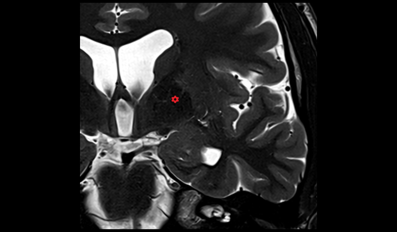 Globus pallidus medial segment mri 3t coronal image
