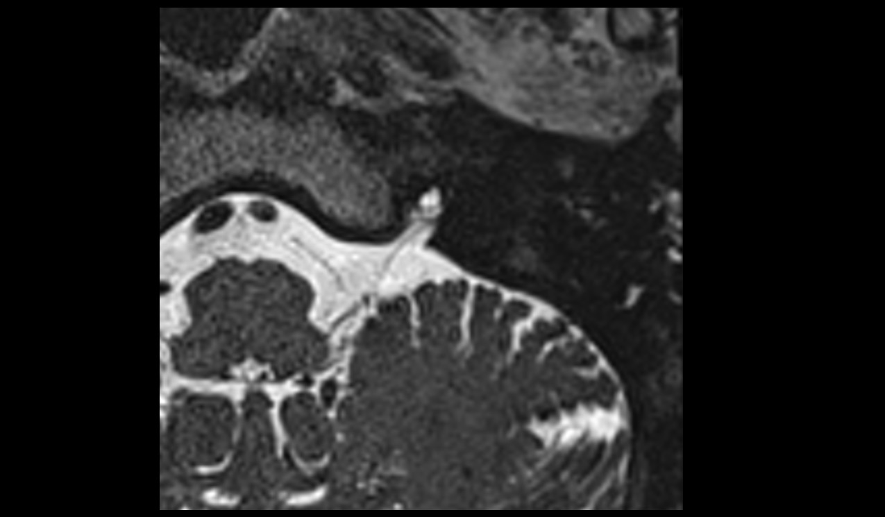 Glossopharyngeal nerve (Cranial nerve IX) MRI 3T axial image