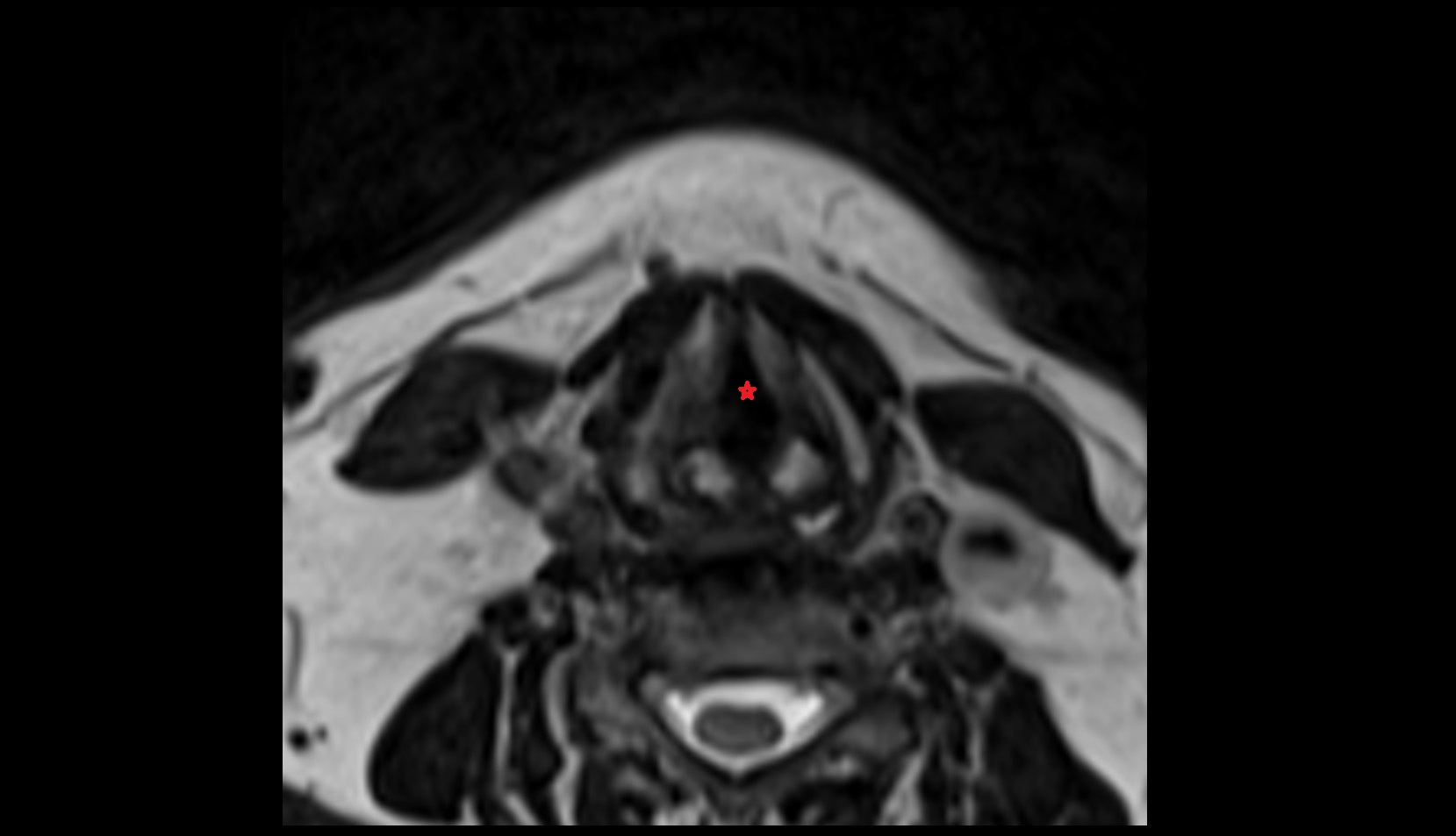 Glottis mri axial image