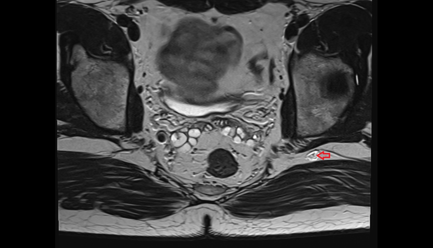 Gluteal lymph nodes   MRI  axial  anatomy  image-img-00000-00000