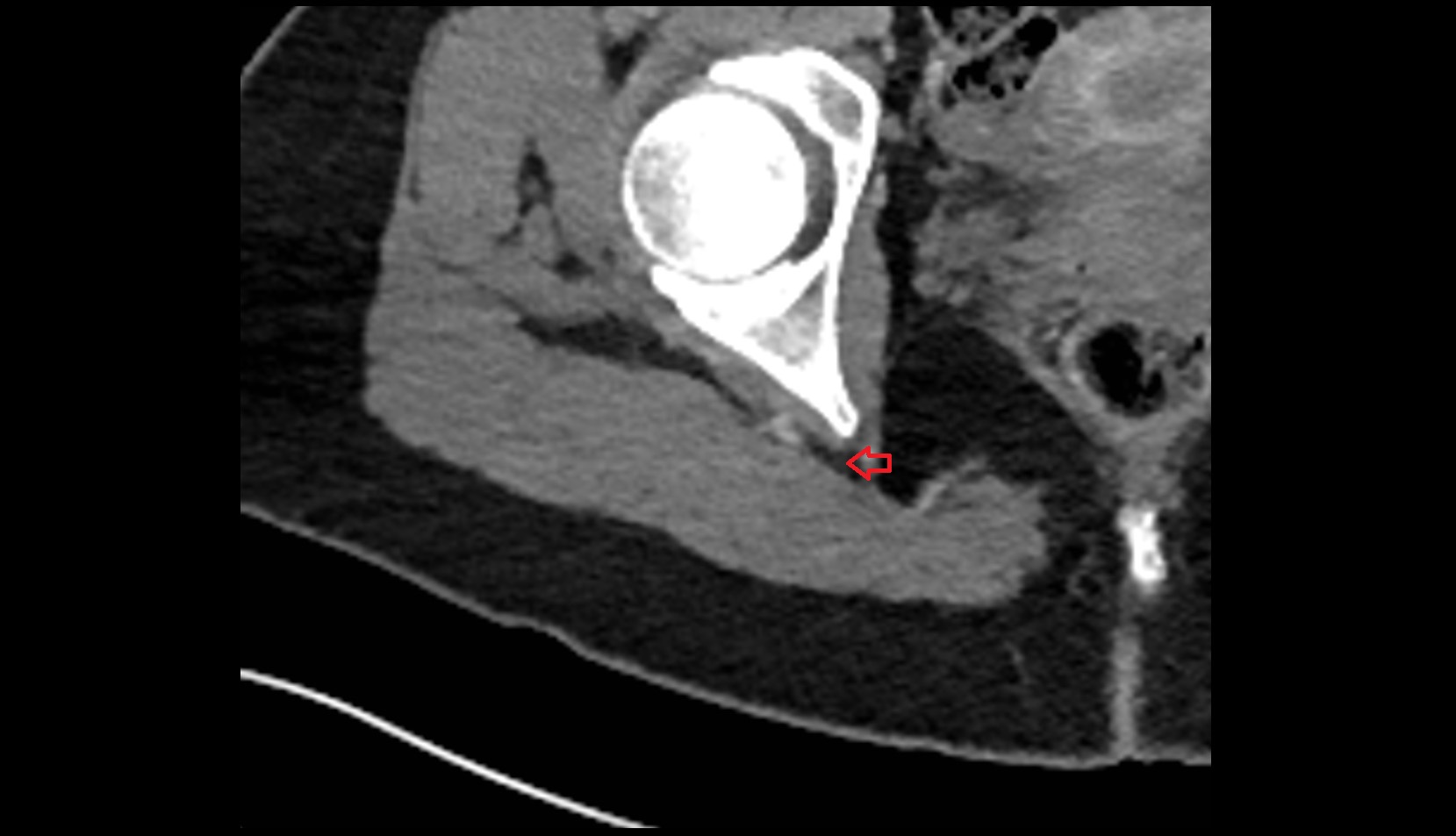 Gluteal lymph nodes ct axial