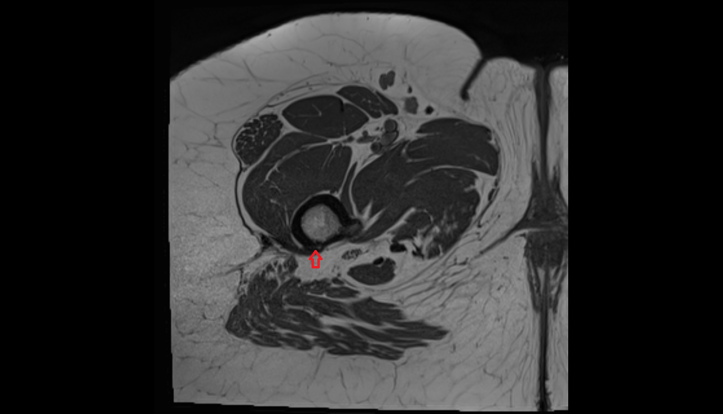 Gluteal tuberosity  MRI axial image-img-00000-00000