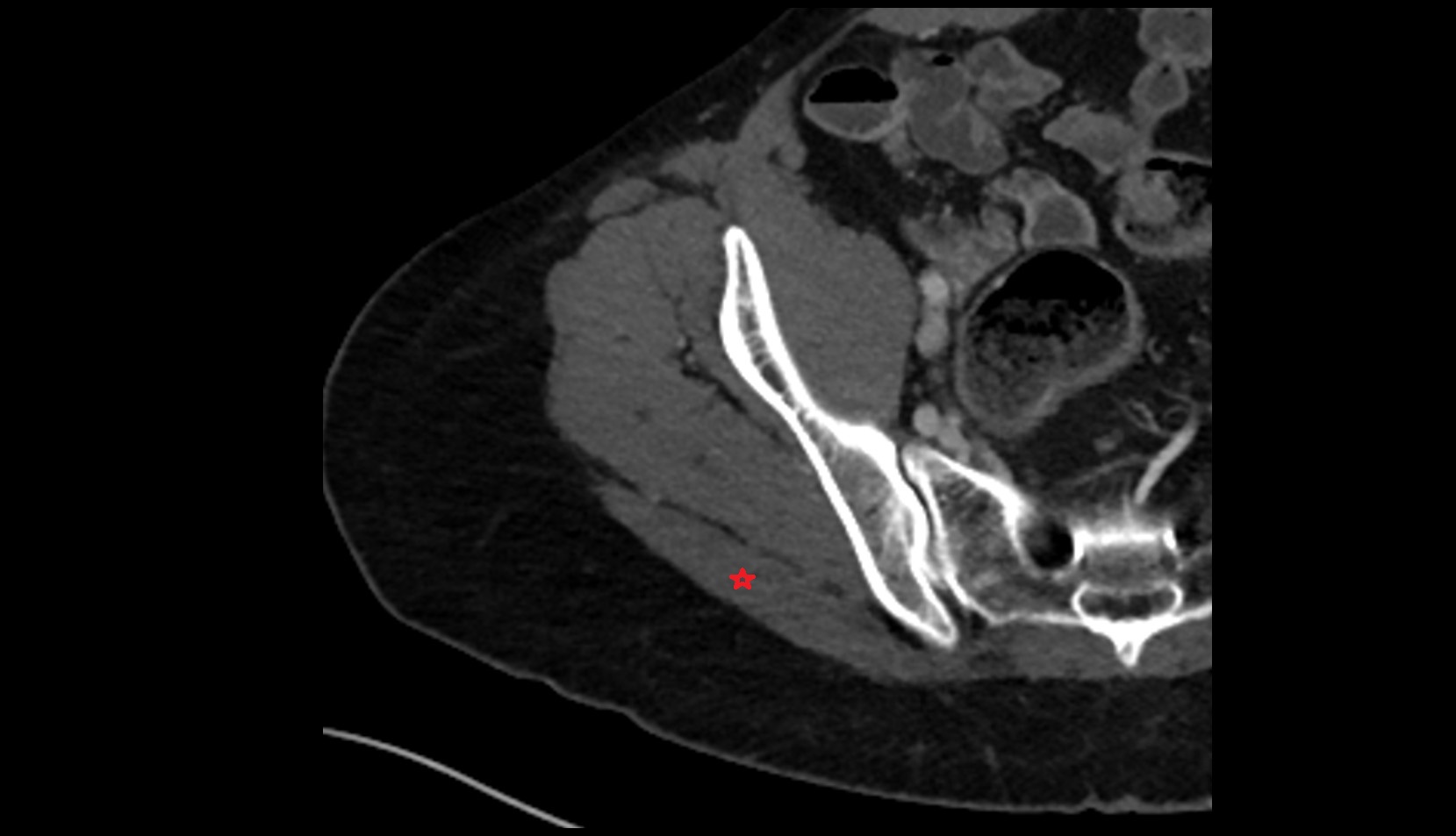 Gluteus maximus muscle CT axial image