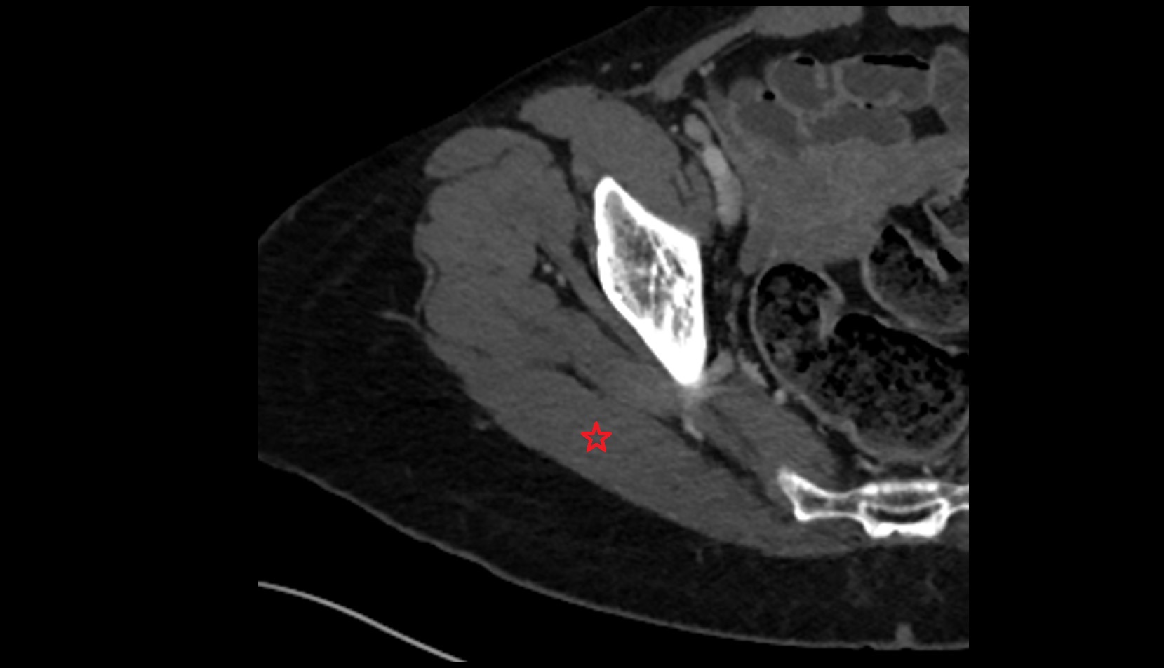 Gluteus maximus muscle CT axial image 1