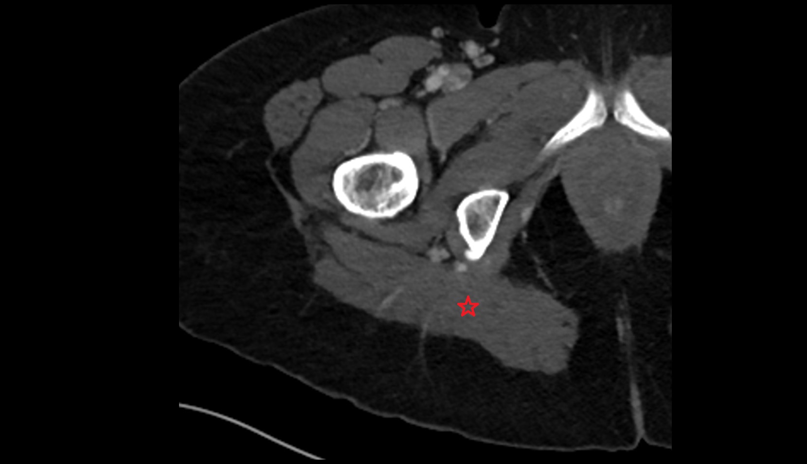 Gluteus maximus muscle CT axial image 3