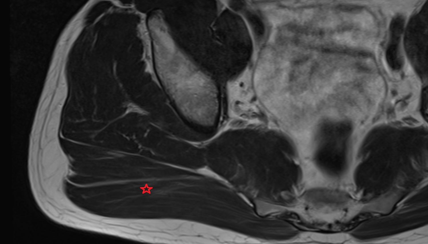 Gluteus maximus muscle  MRI  coronal  image anatomy  image -img-00000-00000_00001