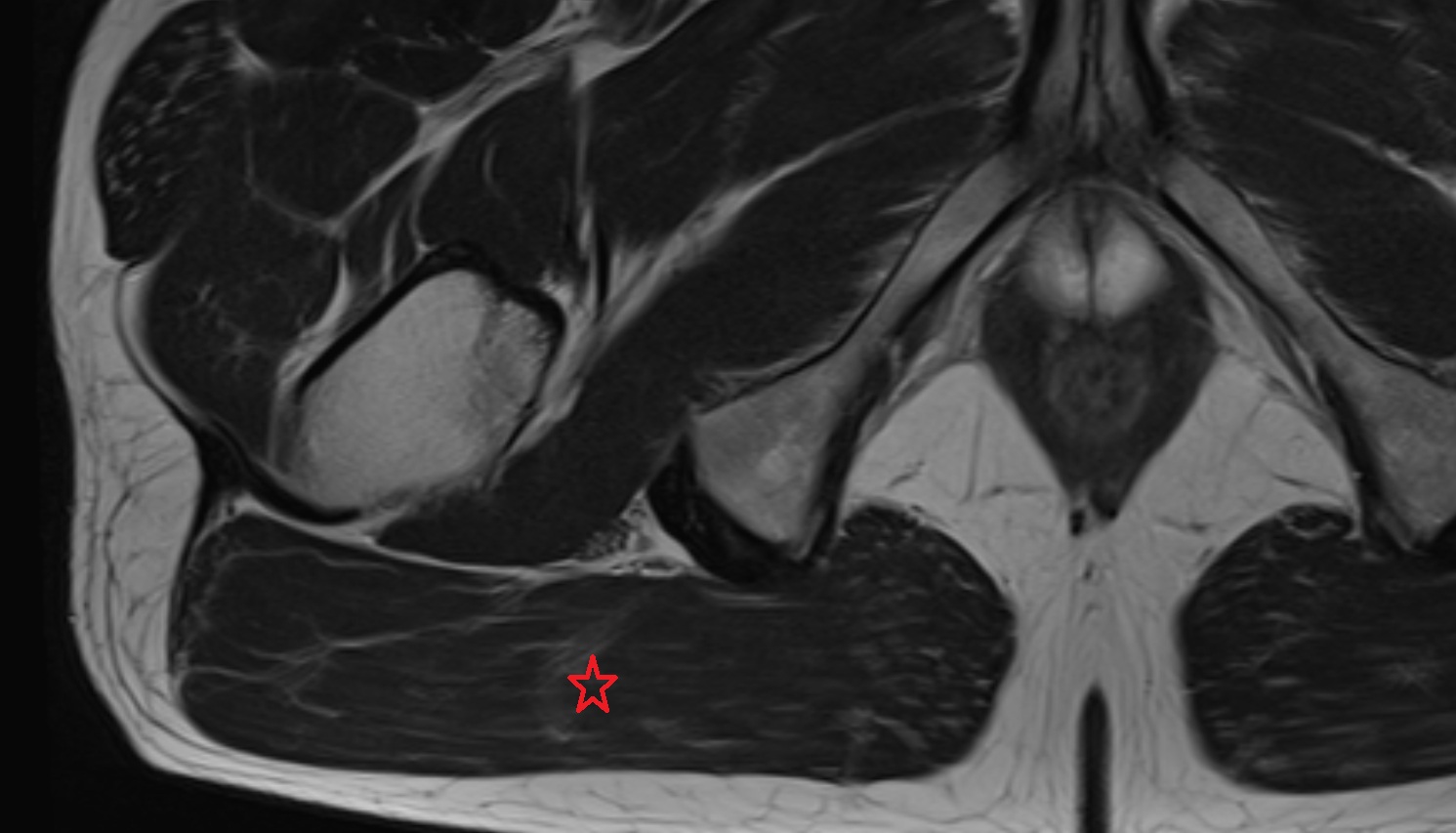 Gluteus maximus muscle  MRI  coronal  image anatomy  image -img-00000-00000_00002