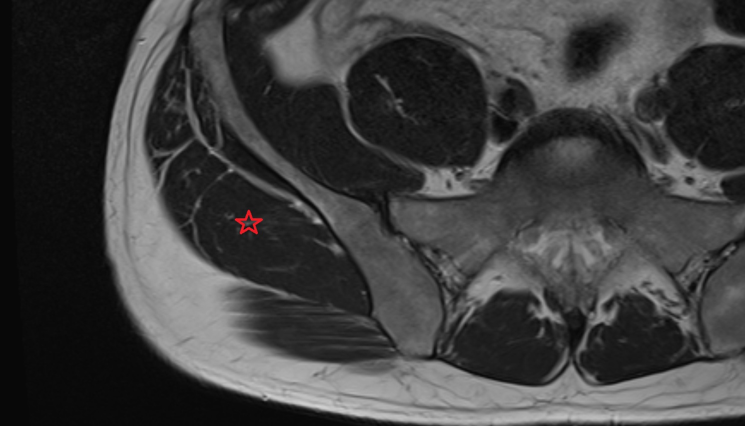 Gluteus medius muscle   MRI  coronal  image anatomy  image -img-00000-00000