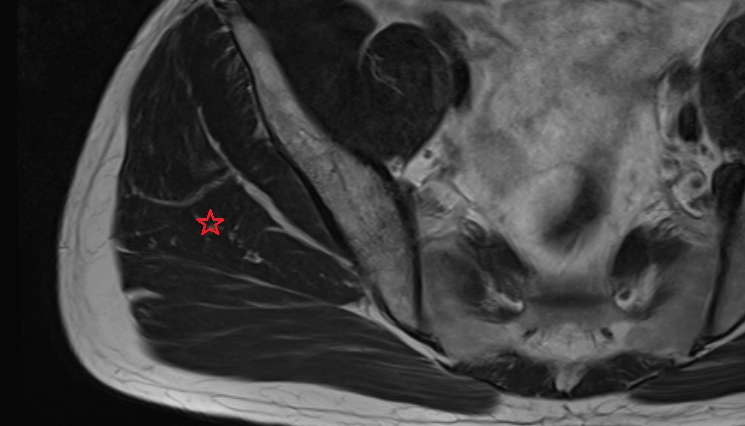 Gluteus medius muscle   MRI  coronal  image anatomy  image -img-00000-00000_00001