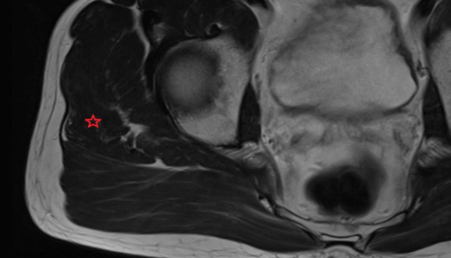 Gluteus medius muscle   MRI  coronal  image anatomy  image -img-00000-00000_00002