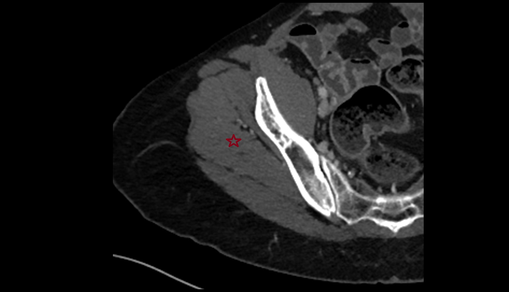 Gluteus medius muscle ct axial image