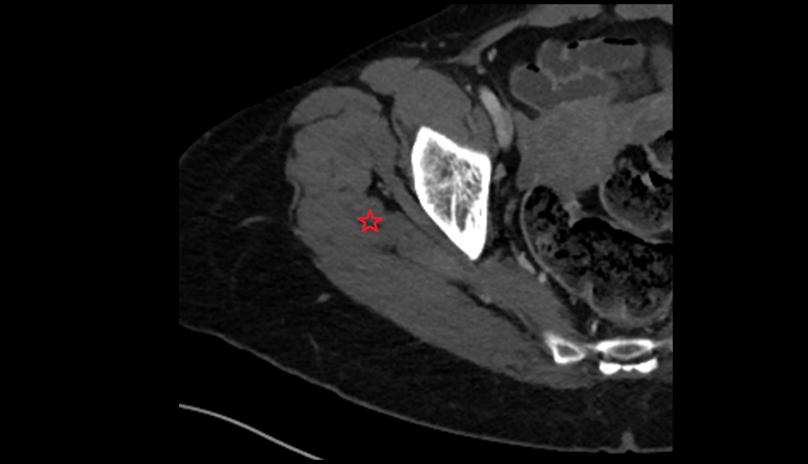Gluteus medius muscle ct axial image  1