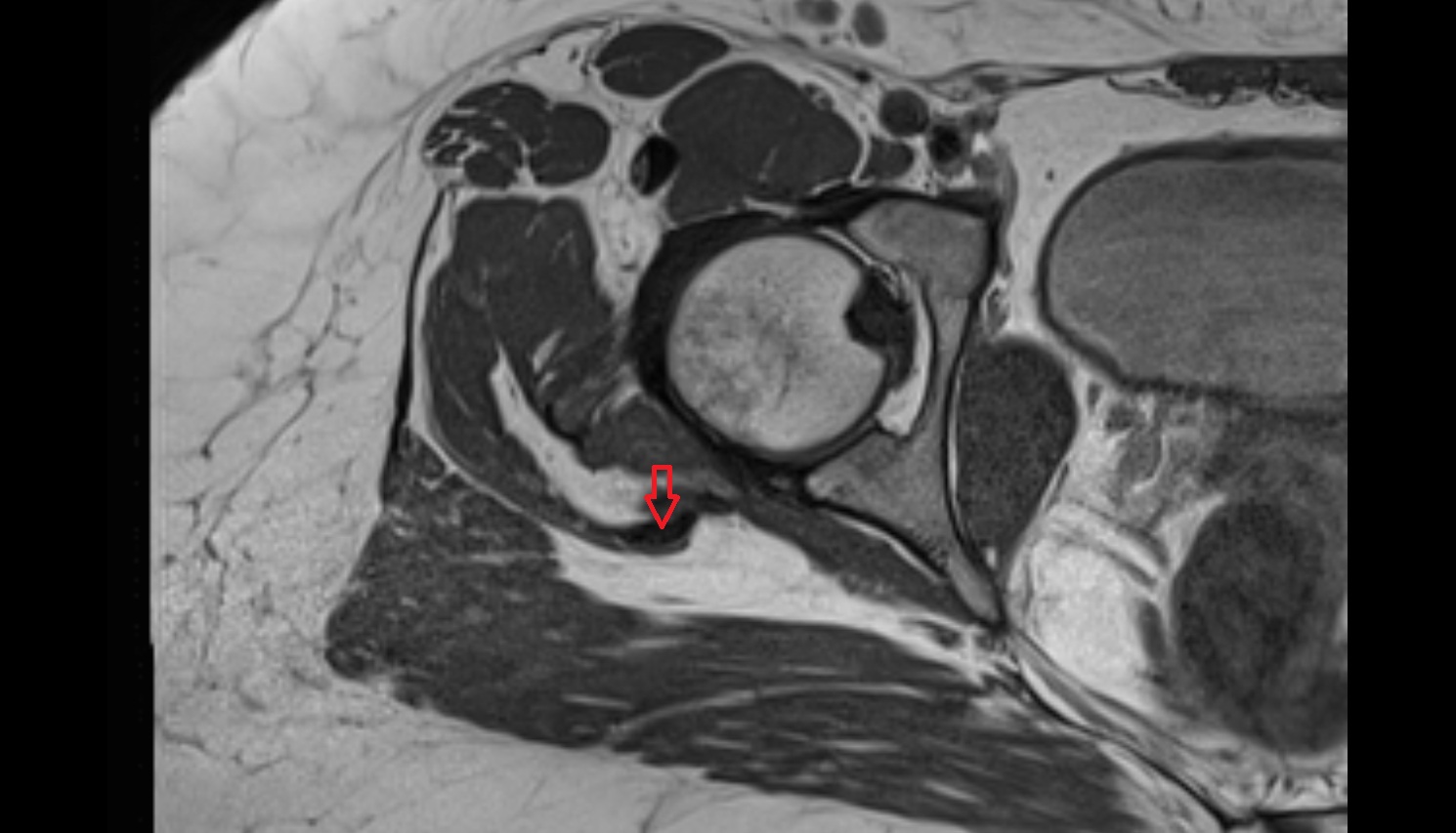 Gluteus medius tendon  MRI axial anatomy image-img-00000-00000