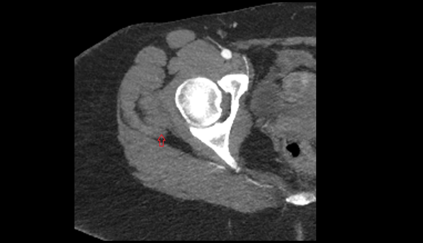 Gluteus medius tendon mri axial image