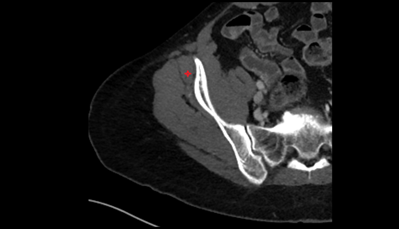 Gluteus minimus muscle CT axial image