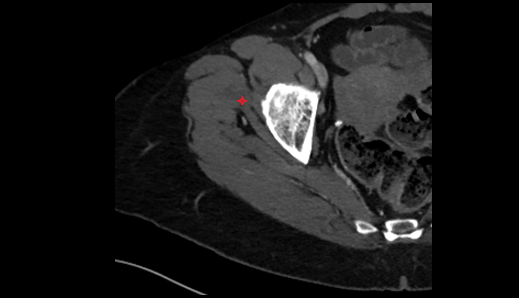 Gluteus minimus muscle CT axial image 3