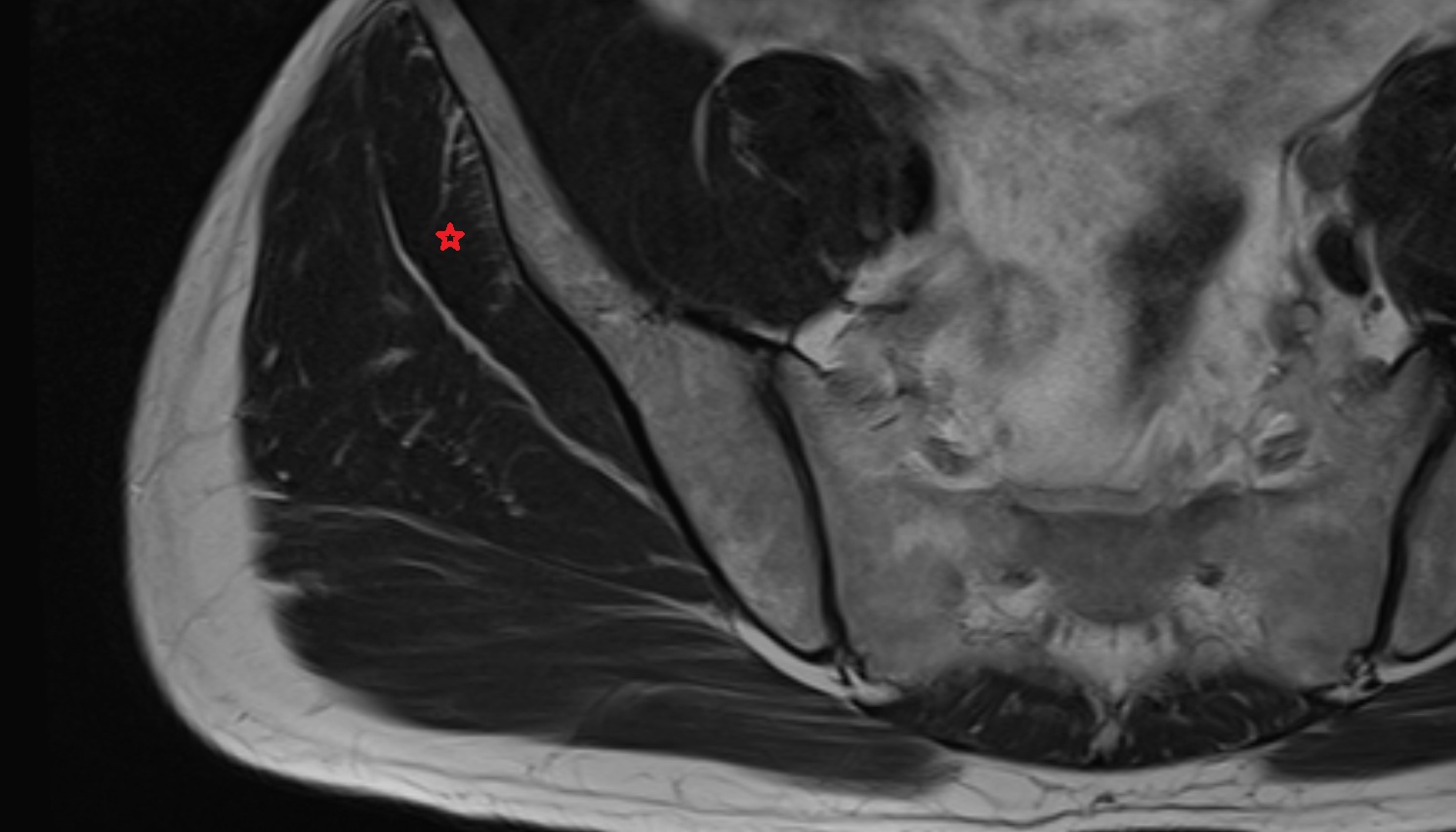 Gluteus minimus muscle   MRI  coronal  image anatomy  image -img-00000-00000