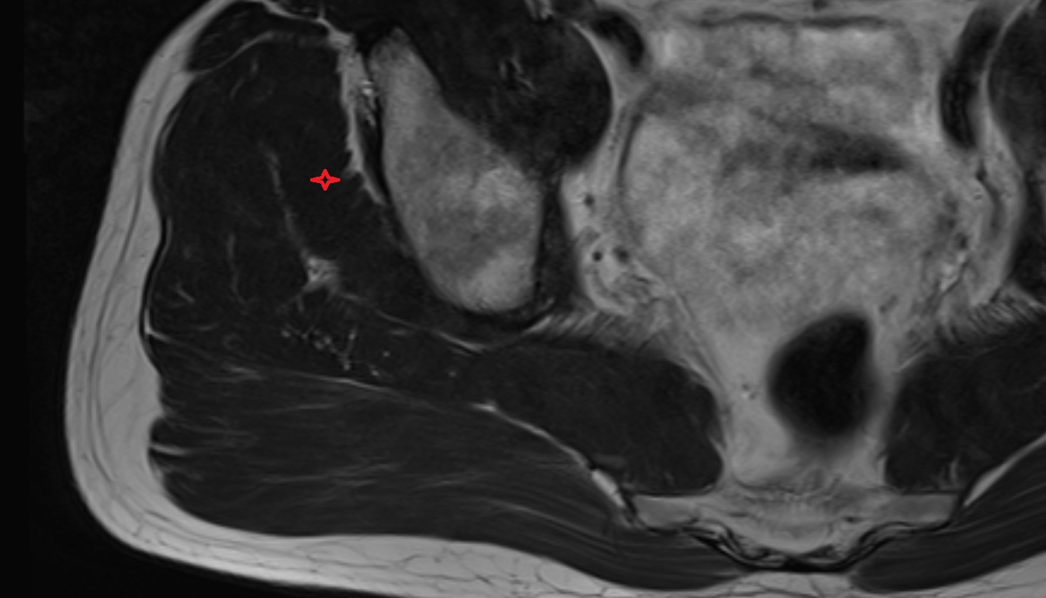 Gluteus minimus muscle   MRI  coronal  image anatomy  image -img-00000-00000_00001
