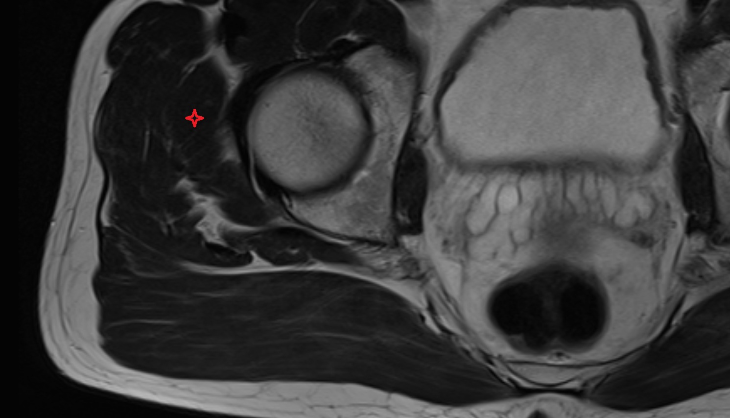 Gluteus minimus muscle   MRI  coronal  image anatomy  image -img-00000-00000_00002