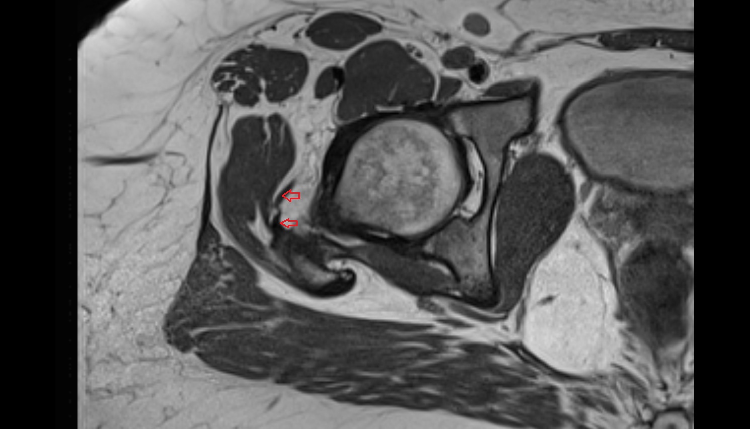 Gluteus minimus tendon  MRI axial anatomy image-img-00000-00000