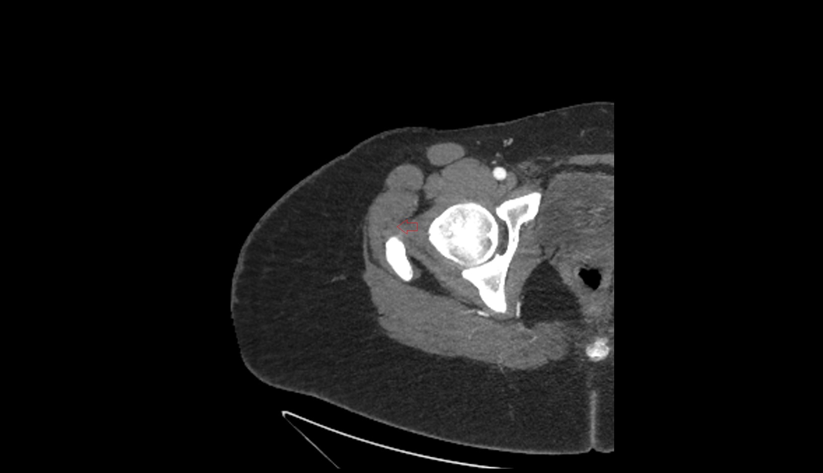 Gluteus minimus tendon ct axial