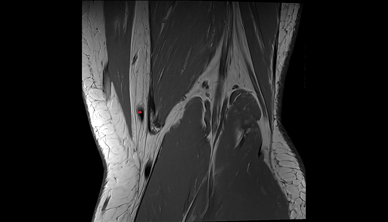Gracilis Tendon (Distal) coronal  cross sectional anatomy 3T MRI AI enhanced  radiology  anatomy image-img-00000-00000