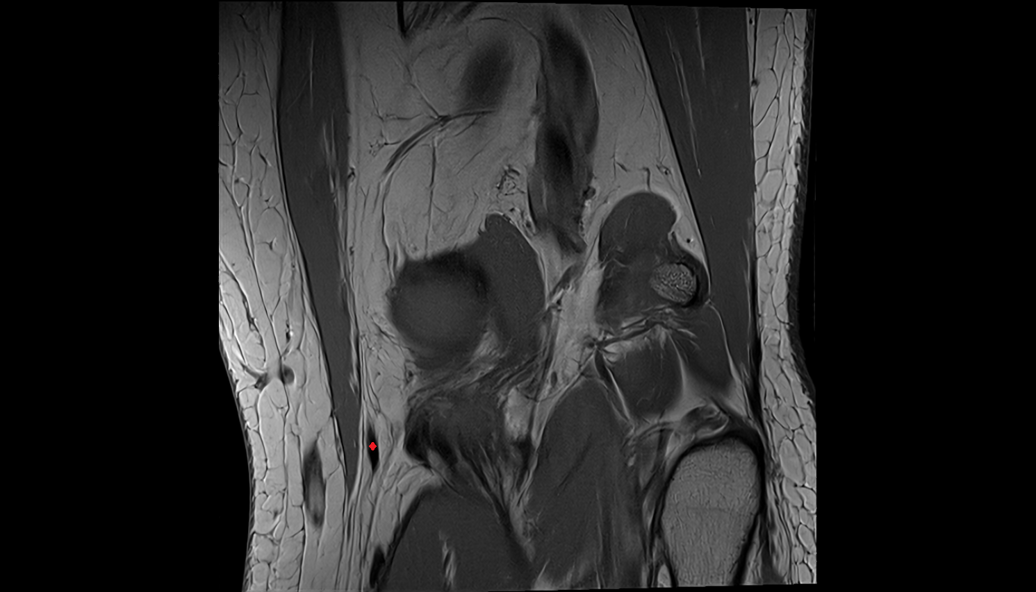 Gracilis Tendon (Distal) coronal  cross sectional anatomy 3T MRI AI enhanced  radiology  anatomy image-img-00000-00000_00001