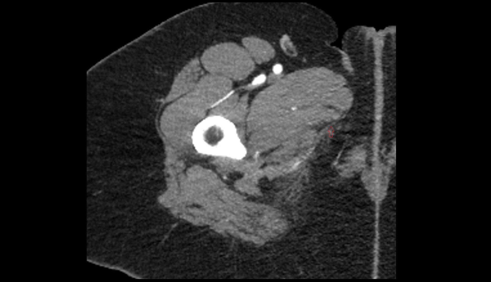 Gracilis Tendon (Proximal) CT AXIAL IMAGE