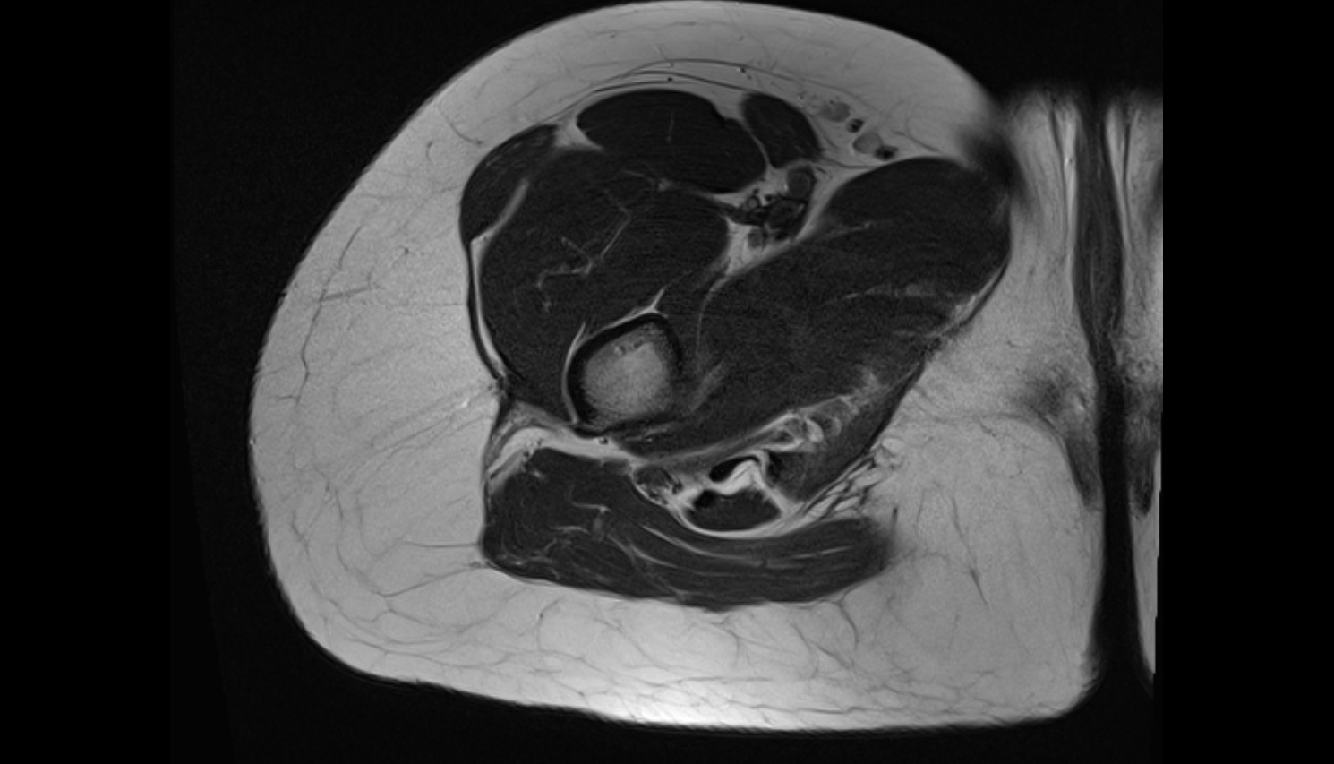 Gracilis Tendon (Proximal)  MRI AXIAL anatomy image-img-00000-00000